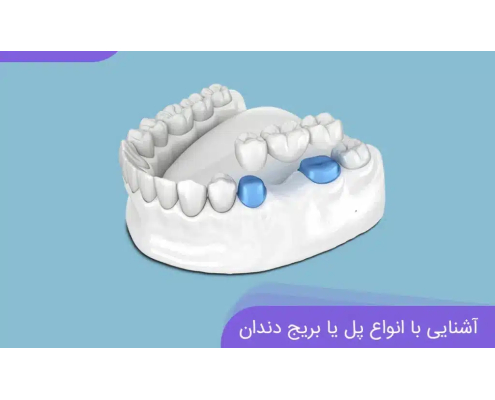 بریج دندان