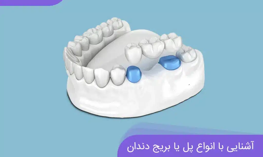 بریج دندان