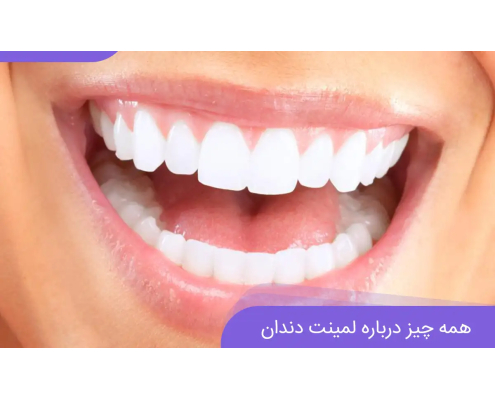 لمینت دندان ارزان