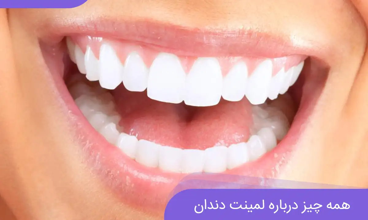 لمینت دندان 1 لمینت دندان ارزان