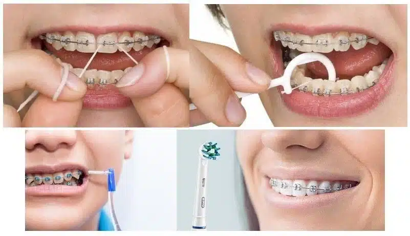 زمان مناسب ارتودنسی و طول درمان