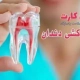 هزینه عصب کشی دندان ۱۴۰۳