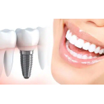 dental-implant