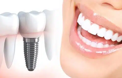 dental-implant