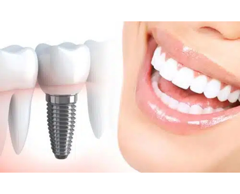 dental-implant