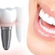 dental-implant