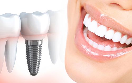 dental implant - هزینه ایمپلنت دندان