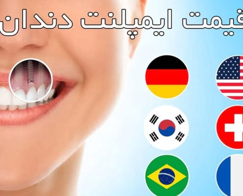ایمپلنت دندان ارزان
