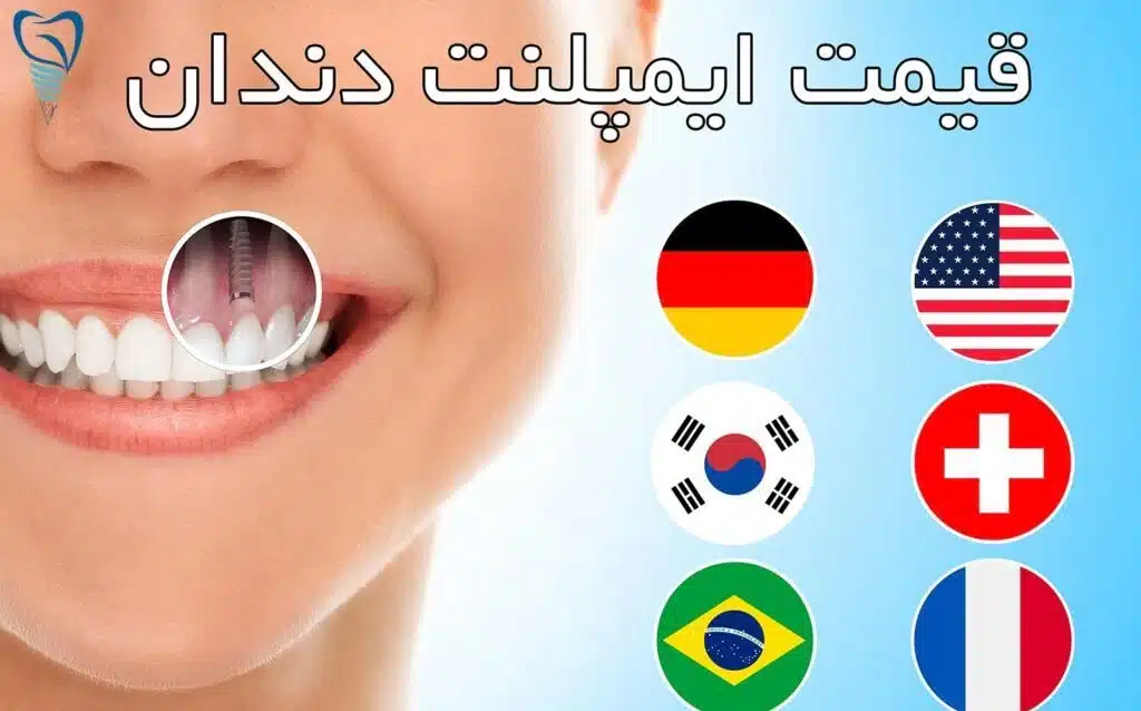 ایمپلنت دندان
