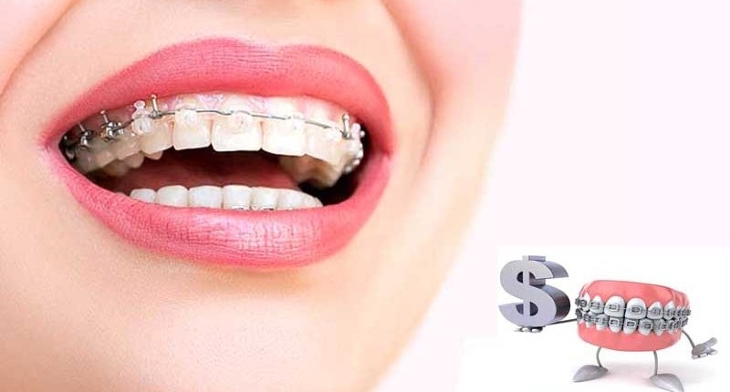 ارتودنسی تخصصی با پوشش بیمه بنیان سلامت