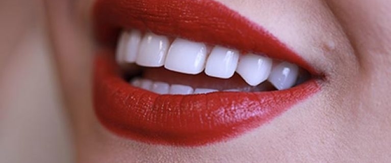ترمیم دندان با کامپوزیت و لمینت دکتر مهتری